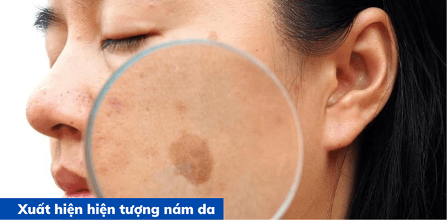 Con dao hai lưỡi khi điều trị các vết nám trên da