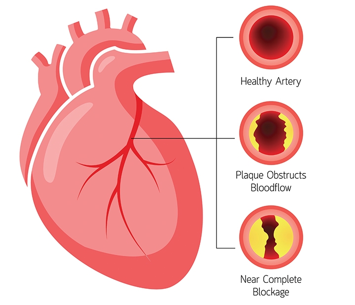 Dấu hiệu 3 loại bệnh tim mạch nguy hiểm bạn cần biết