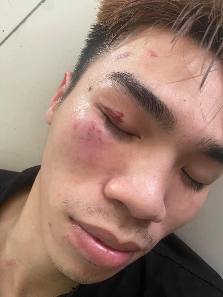 hình ảnh vết thương của võ sĩ Nguyễn Minh Đức ( nguồn facebook : Anh's Béo'ss)
