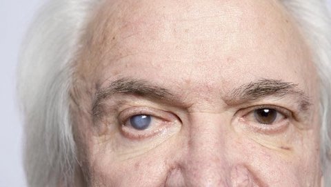 6 vấn đề liên quan đến mắt người cao tuổi cần đặc biệt lưu ý