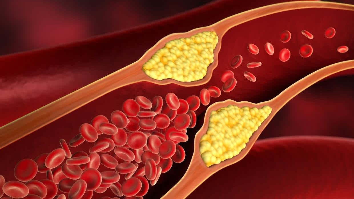Cholesterol cao và những biến chứng khôn lường