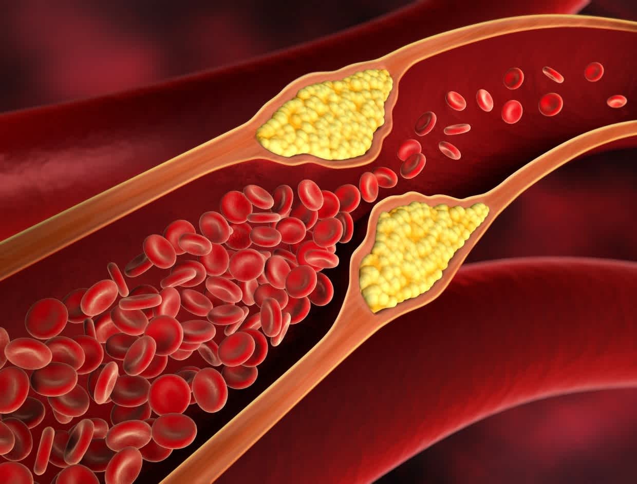 Cholesterol cao và những biến chứng khôn lường